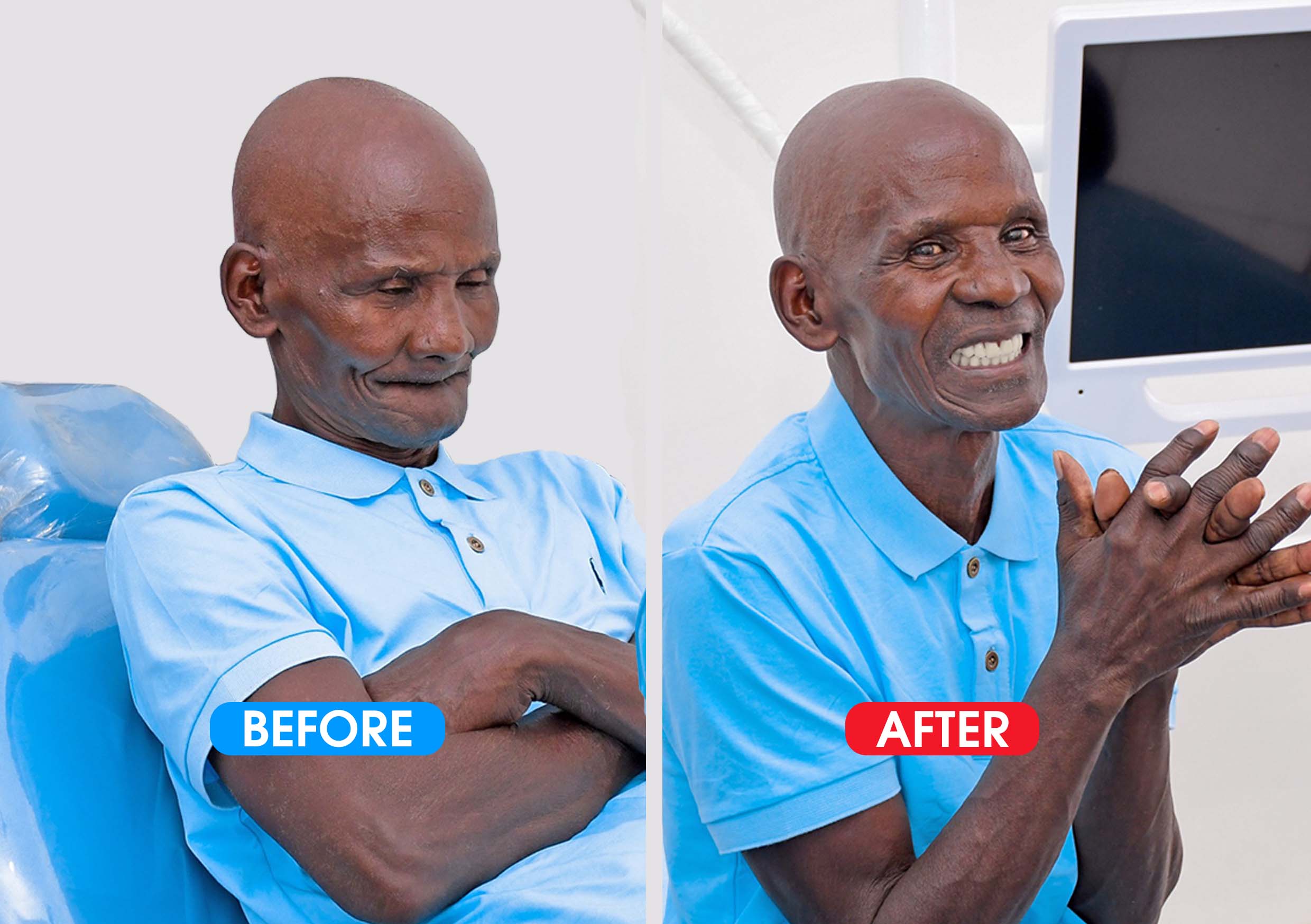 Smile Restoration to the Elderly