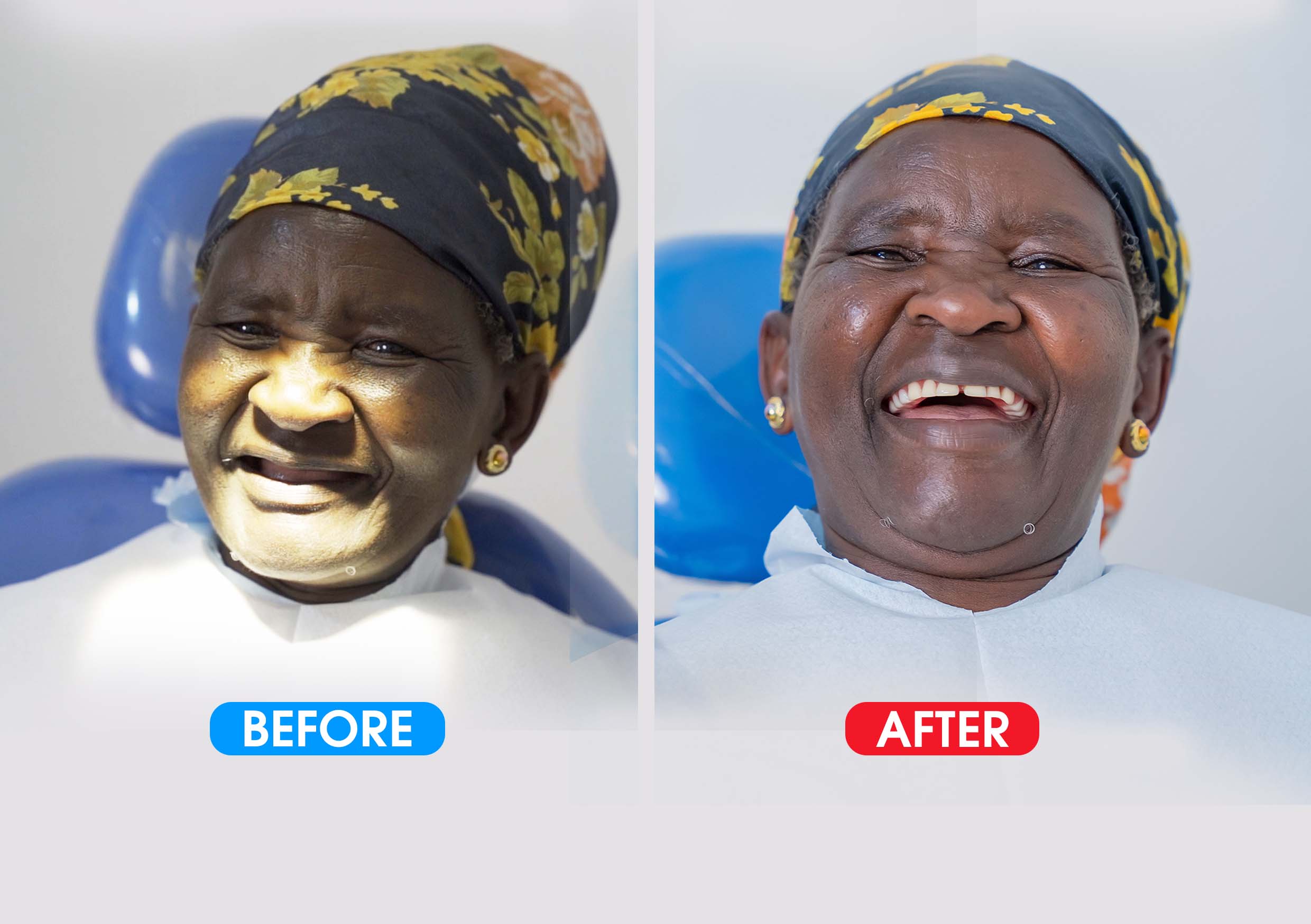 Smile Restoration to the Elderly