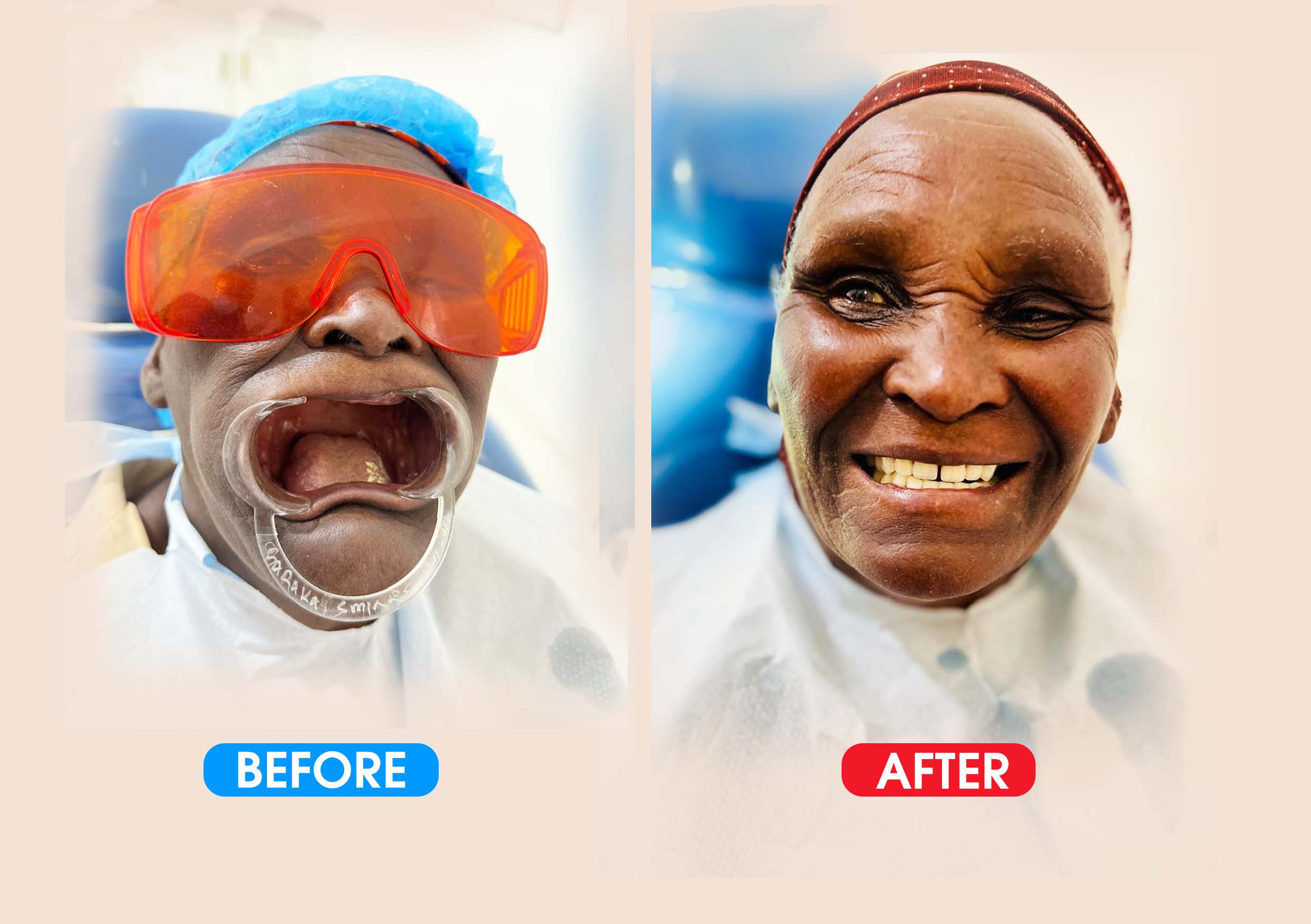 Smile Restoration to the Elderly